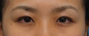 症例写真,アイプチで被れた目に埋没法で二重を作った症例写真,After(メイクあり)<br/>
(1ヶ月後),