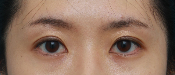 症例写真,埋没法で自然で似合っている末広型二重を作った症例写真,After(メイクあり)<br/>
(1週間後),