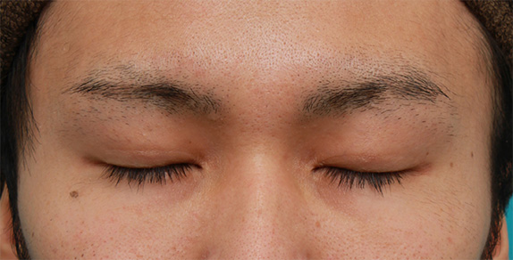 症例写真,周囲に気付かれないように二重まぶた埋没法を行った男性患者様の症例写真,After(目を閉じた状態)<br/>
(3ヶ月後),