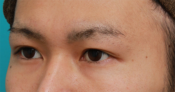 症例写真,周囲に気付かれないように二重まぶた埋没法を行った男性患者様の症例写真,After(3ヶ月後),ba_maibotsu41_b.jpg