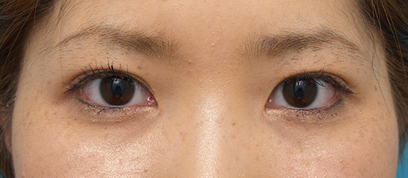 症例写真,二重まぶた・ミニ切開法(部分切開)の症例 術後1ヶ月、目もとがくっきりした20代女性,After(メイクあり)<br/>
(1ヶ月後),