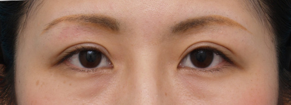 症例写真,ミニ切開二重の症例写真,After(メイクあり)<br/>
(2ヶ月後),