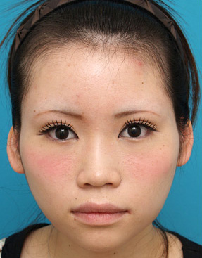症例写真,二重まぶた・ミニ切開法(部分切開)の症例 目頭切開、垂れ目形成、ボツリヌストキシン注射(エラ、プチ小顔術)も施行,After(メイクあり),