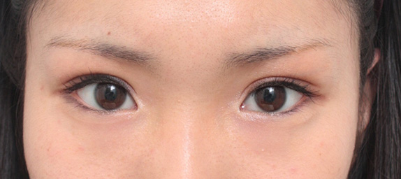 症例写真,埋没法で幅広平行二重にしたが、ミニ切開法でやり直した症例写真,After(メイクあり),