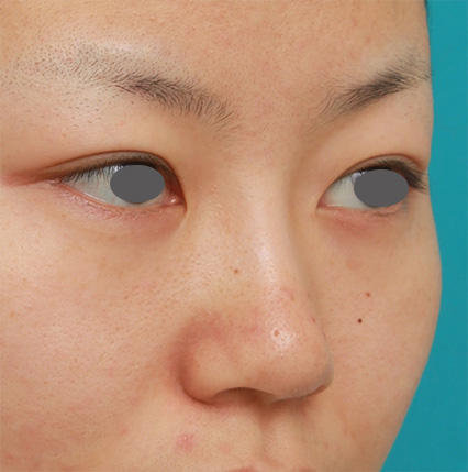 症例写真,鼻のシリコンプロテーゼ+鼻翼(小鼻)縮小手術の症例写真,After(6ヶ月後),ba_ryubi56_b.jpg