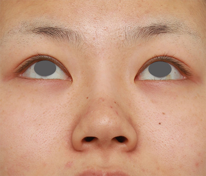 症例写真,鼻のシリコンプロテーゼ+鼻翼(小鼻)縮小手術の症例写真,After(6ヶ月後),ba_ryubi58_b.jpg
