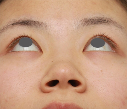 症例写真,鼻のシリコンプロテーゼ+鼻翼(小鼻)縮小手術の症例写真,Before,ba_ryubi58_b.jpg