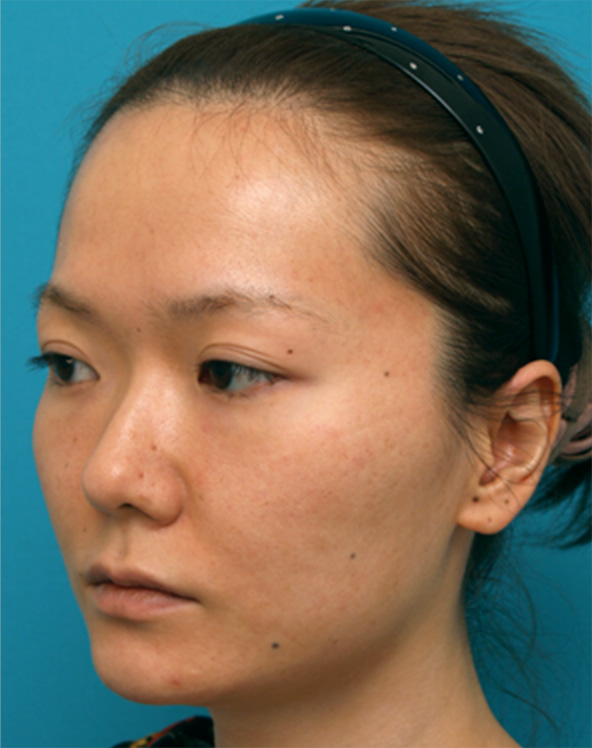 症例写真,隆鼻注射(ヒアルロン酸注射)の症例 鼻と涙袋をプチ整形した20代女性,Before,ba_ryubichusha27_b.jpg