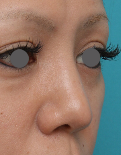 症例写真,耳介軟骨移植(鼻先を出す)の症例 他院で入れたL型プロテーゼをI型プロテーゼへ入れ替えも施行,After,ba_jikai15_b.jpg