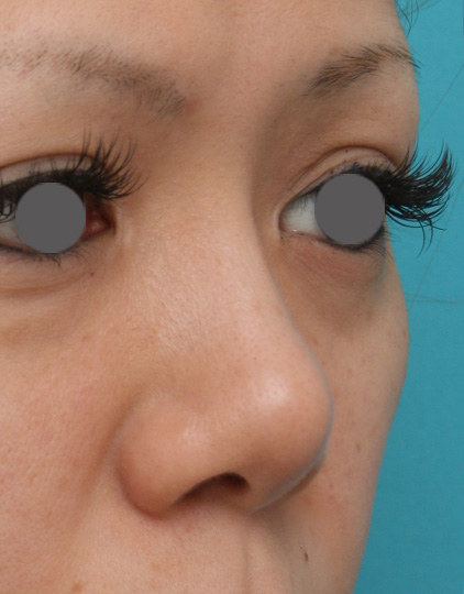 症例写真,耳介軟骨移植(鼻先を出す)の症例 他院で入れたL型プロテーゼをI型プロテーゼへ入れ替えも施行,Before,ba_jikai15_b.jpg