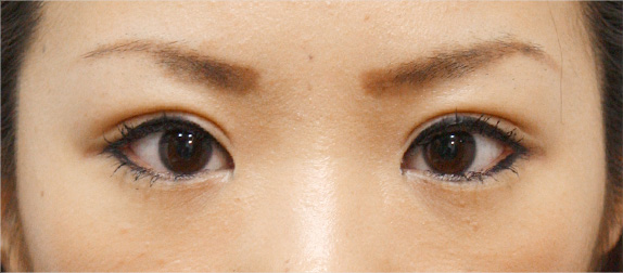症例写真,二重まぶた・全切開法の症例 術後1ヶ月経過した20代女性,After(メイクあり)<br/>
(1ヶ月後),