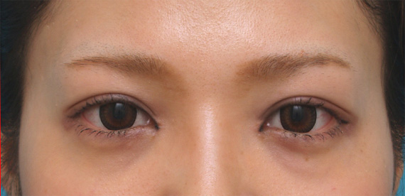 症例写真,目頭切開+全切開二重でやや幅の広い平行型二重を作った症例写真,After(メイクあり)<br/>
(3ヶ月後),