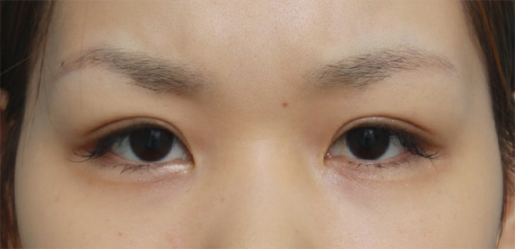 症例写真,二重まぶた・全切開法の症例 術前は完全な一重まぶただった20代女性,After(メイクあり)<br/>
(6ヶ月後),