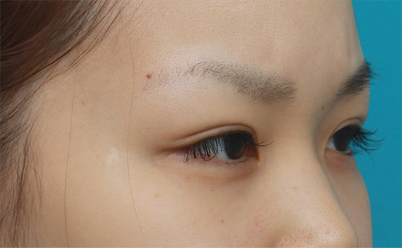 症例写真,二重まぶた・全切開法の症例 術前は完全な一重まぶただった20代女性,After(メイクなし),ba_sekkai28_b.jpg