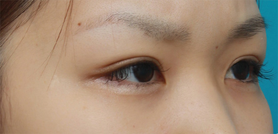 症例写真,二重まぶた・全切開法の症例 術前は完全な一重まぶただった20代女性,After(メイクあり)<br/>
(6ヶ月後),