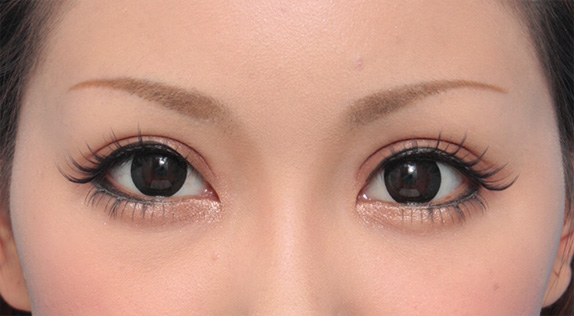 症例写真,患者様の希望で二重まぶた全切開法でかなり幅の広い平行型二重を作った症例写真,After（メイクあり）<br/>
（6ヶ月後）,