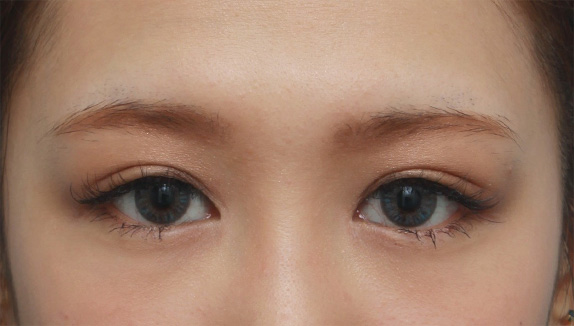 症例写真,目頭切開+二重まぶた全切開法でやや幅の広い平行型二重を作った症例写真,After(メイクあり)<br/>
(6ヶ月後),