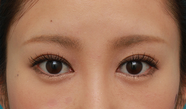 目頭切開,目頭切開+目尻切開で目の横幅を内側と外側に広げた20代女性の症例写真,4ヶ月後,メイクあり,mainpic_megashira32f.jpg