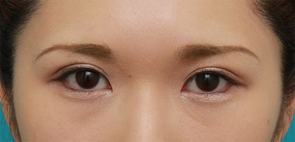 症例写真,二重まぶた全切開法で平行型と末広型の中間くらいの二重を作った症例写真の術前術後画像,After(メイクあり)<br/>
(4ヶ月後),