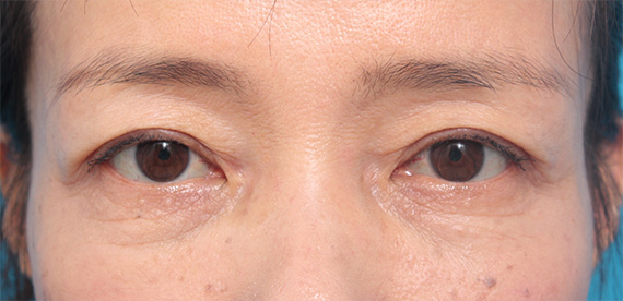 症例写真,60代女性に二重のラインで上まぶたたるみ取りを行い、綺麗な二重を作った症例写真,After(3ヶ月後),ba_menouetarumi01_b.jpg