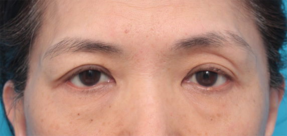 症例写真,片目の上まぶたたるみ取り手術をして二重を作り、左右差を修正した症例写真,After(2ヶ月後),ba_tarumi23_b.jpg