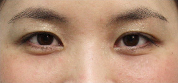 症例写真,目の下の脂肪取りの症例 目の下のクマ治療のため脂肪を取った30代女性,After(1週間後),ba_shibo04_b.jpg