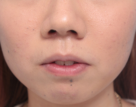 症例写真,タラコ唇の人に、手術で上下の唇を薄くした症例写真,After(10日後),ba_usuku13_b.jpg