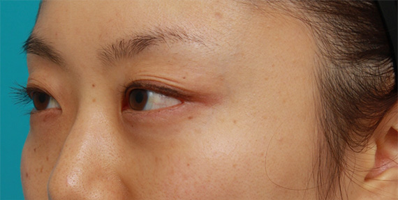 症例写真,目の下の脂肪取り症例写真,After(1ヶ月後),ba_shibo09_b.jpg