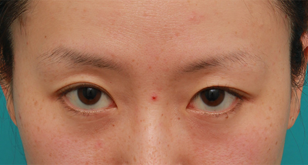 症例写真,片目のみ目の下の脂肪取りをして左右対称に近づけた症例写真の術前術後画像,After(4ヶ月後),ba_shibo14_b.jpg