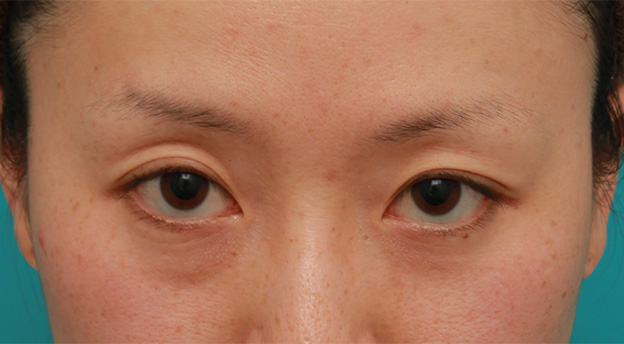 症例写真,片目のみ目の下の脂肪取りをして左右対称に近づけた症例写真の術前術後画像,Before,ba_shibo14_b.jpg