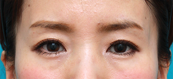 症例写真,目の上の窪みにヒアルロン酸を注射し、二重のラインをはっきりさせた症例写真,After(メイクあり)<br/>
(1週間後),