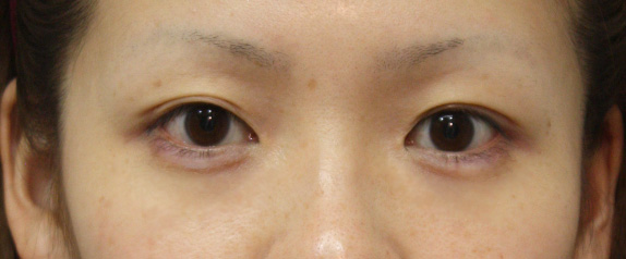 症例写真,なみだ袋形成(ヒアルロン酸注射)の症例 淋しい顔立ちを解消したい女性,After,ba_namida04_b.jpg