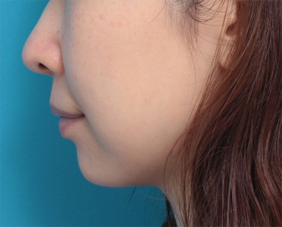 症例写真,アゴのない人に6mmのシリコンプロテーゼを入れ、先細り効果で小顔に見えるようにした症例写真,After(3ヶ月後),ba_ago23_b.jpg