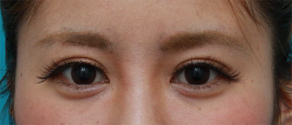 なみだ袋形成(ヒアルロン酸注射),ミニ切開法で二重を作った後、ヒアルロン酸で大きめな涙袋を作った症例写真,After(メイクあり)<br/>
(1週間後),