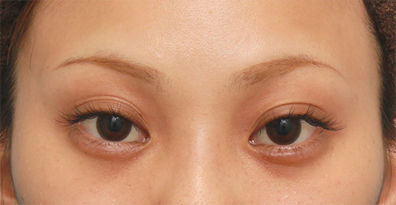 症例写真,キツいつり目にヒアルロン酸注射で涙袋を作り、優しい印象の目にした症例写真の術前術後,After(3ヶ月後),ba_namida17_b.jpg