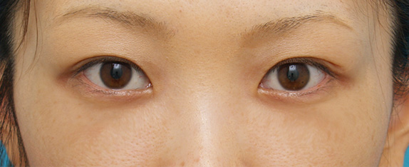 症例写真,目の下のクマ治療の症例 遺伝的に下まぶたの脂肪がつきやすいやすい20代女性,After(メイクあり)<br/>
(1週間後),