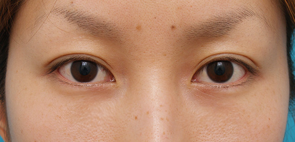 症例写真,目の下のクマ治療の症例 20代女性の目の下の脂肪取り /クマ治療,After(1週間後),ba_kuma07_b.jpg