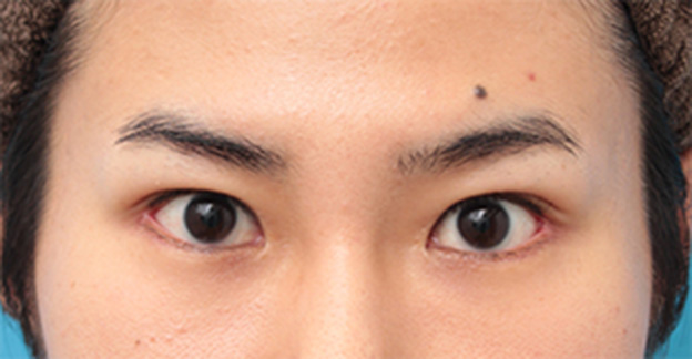 症例写真,目尻切開+タレ目形成(グラマラスライン)で目を一回り大きくした男性の症例写真の術前術後画像,1ヶ月後,mainpic_panda07d.jpg