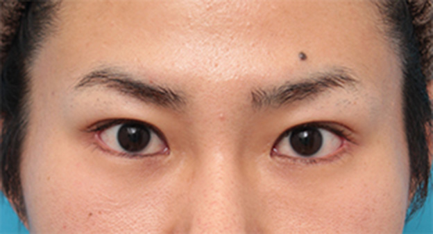 症例写真,目尻切開+タレ目形成(グラマラスライン)で目を一回り大きくした男性の症例写真の術前術後画像,6ヶ月後,mainpic_panda07e.jpg