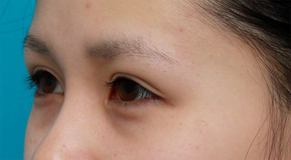 症例写真,他院で行った切開二重を眼瞼下垂手術で修正し目頭切開も行いハーフっぽい印象になった症例写真,After(メイクなし),ba_ganken37_b.jpg