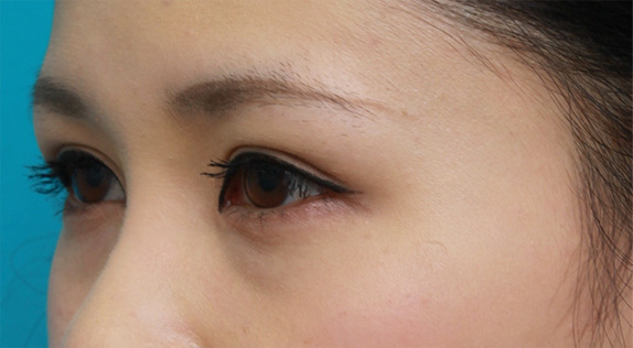 症例写真,他院で行った切開二重を眼瞼下垂手術で修正し目頭切開も行いハーフっぽい印象になった症例写真,After(メイクあり),