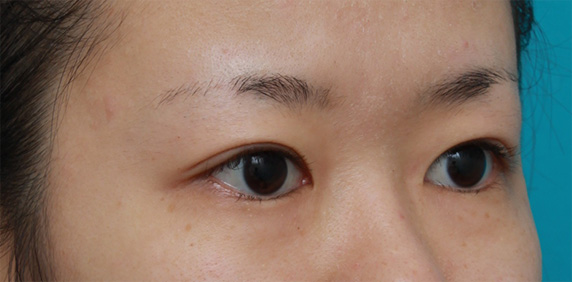 症例写真,非常に厚ぼったい一重まぶたに対して、大量の脂肪を切除して眼瞼下垂手術を行った症例写真,After(6ヶ月後),ba_ganken39_b.jpg