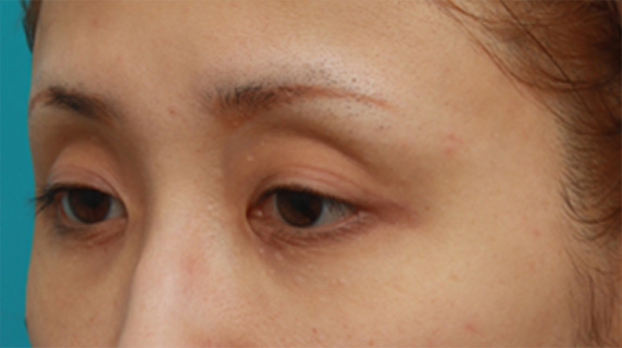 眼瞼下垂(がんけんかすい),眼瞼下垂手術をして、まぶたの窪みを解消させ、二重を作った症例写真,Before,ba_ganken41_b.jpg