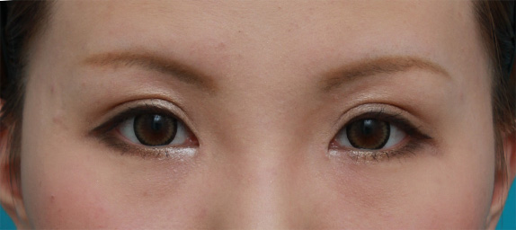 症例写真,目頭切開+眼瞼下垂手術の症例写真,After(メイクあり)<br/>
(6ヶ月後),