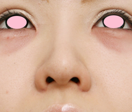 症例写真,鼻尖形成+鼻翼(小鼻)縮小の症例写真,After,ba_bisen10_b.jpg