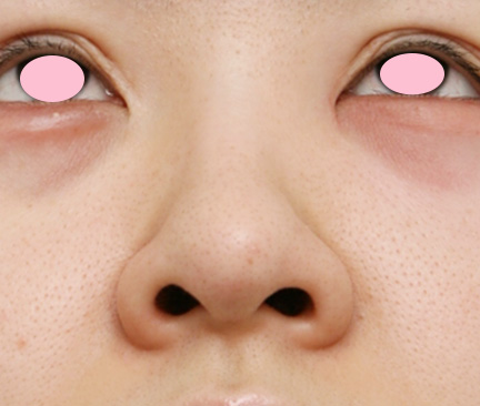 症例写真,鼻尖形成+鼻翼(小鼻)縮小の症例写真,Before,ba_bisen10_b.jpg