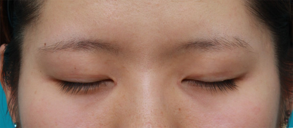 症例写真,目頭切開+眼瞼下垂手術で小さい目を一回り大きくした症例写真,After(目を閉じた状態)<br/>
(6ヶ月後),