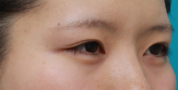 症例写真,目頭切開+眼瞼下垂手術で小さい目を一回り大きくした症例写真,After(6ヶ月後),ba_ganken46_b.jpg