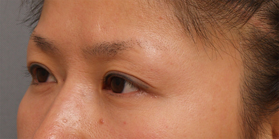 症例写真,眼瞼下垂(がんけんかすい) 左目が三重になっていた30代女性の症例,After(6ヶ月後),ba_ganken48_b.jpg