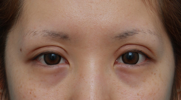 他院で受けた手術の修正(二重まぶた・目もと),他院で切開法で非常に幅の広い二重を作り失敗し、眼瞼下垂手術で幅を狭く修正した症例写真,1ヶ月後,mainpic_ganken11e.jpg